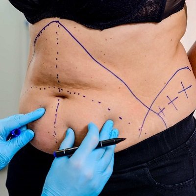 Liposuction in Riyadh Safe Cosmetic Sculpting